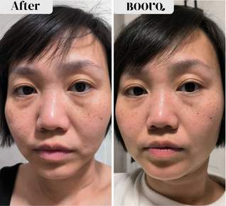 MICRO-INFUSION DART PATCHES