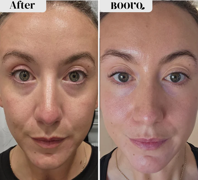 MICRO-INFUSION DART PATCHES