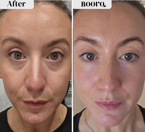 MICRO-INFUSION DART PATCHES