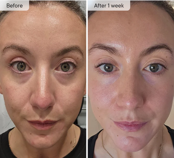 Fast-acting patches feature 80 self-dissolving micro-darts designed to target and treat wrinkles, under-eye puffiness and dark circles.